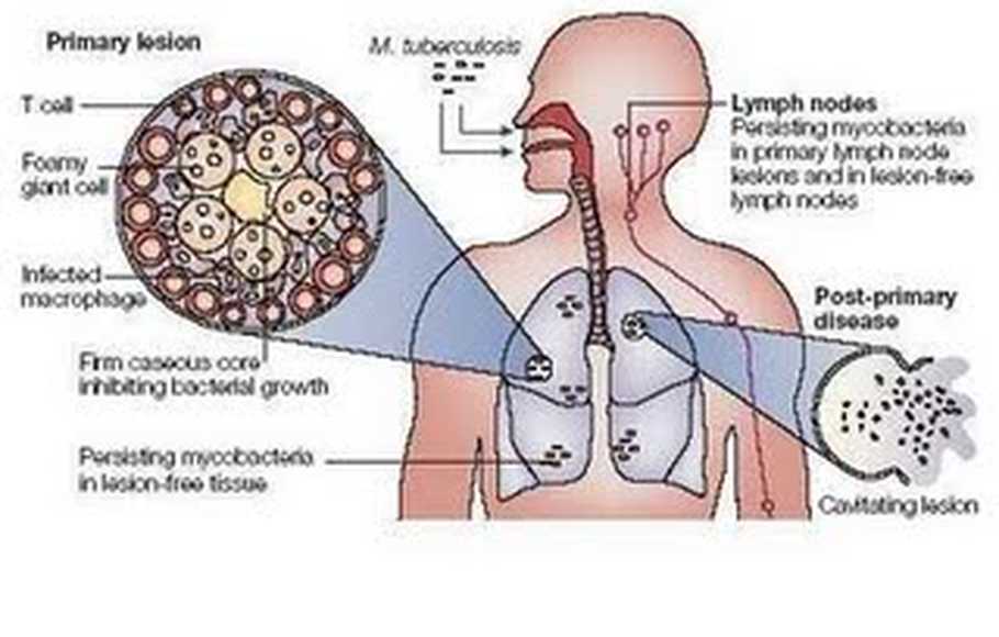 Mycobacterium